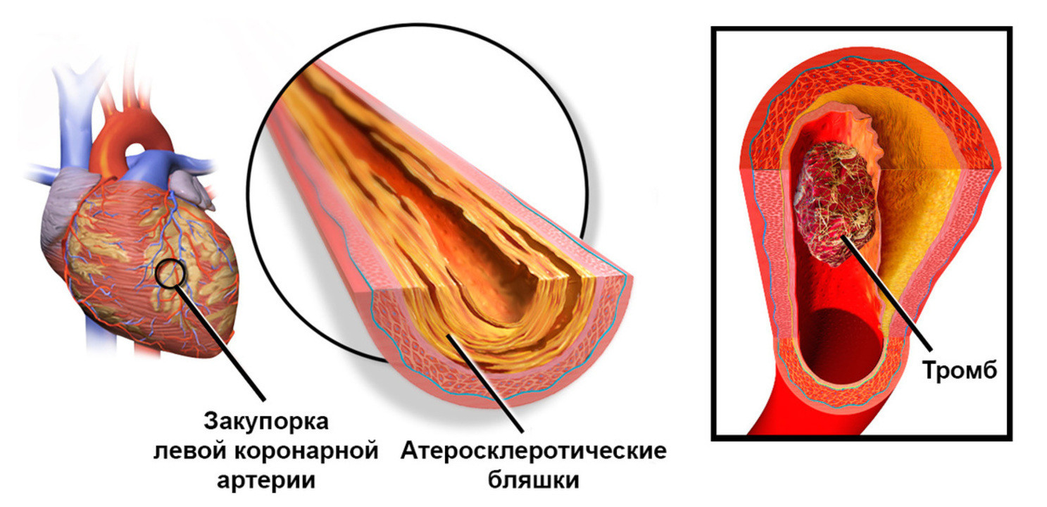 Сосуды нужно беречь